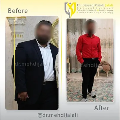 نمونه قبل و بعد از جراحی چاقی