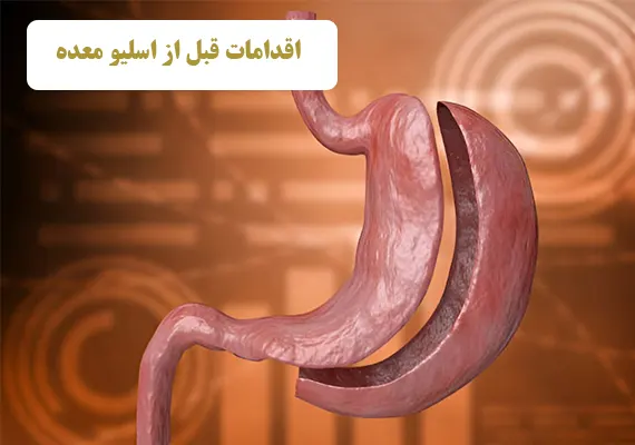 اقدامات قبل از اسلیو معده