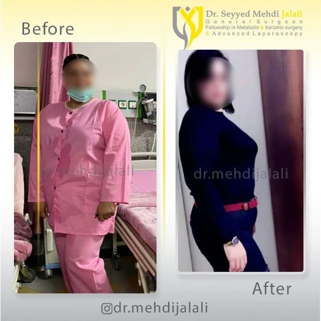قبل و بعد از عمل بای پس معده-دکتر سیدمهدی جلالی 1