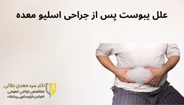 علل یبوست پس از جراحی اسلیو معده علل یبوست پس از جراحی اسلیو معده