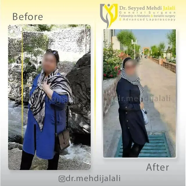 dr.mehdijalali_تصاویر کاهش وزن بعد از لاغری