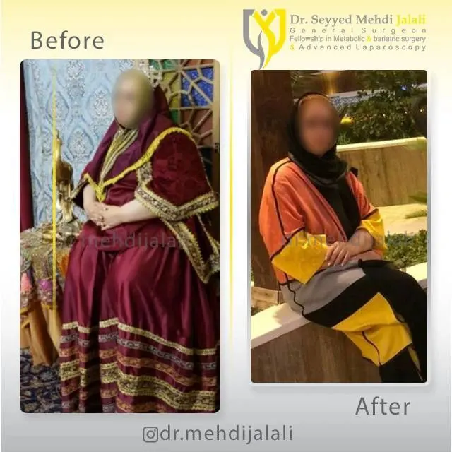 dr.mehdijalali_جراحی کاهش وزن و لاغری