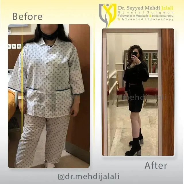 dr.mehdijalali_نمونه کاهش وزن جراحی لافری