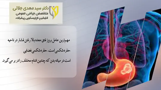 عامل فتق معده