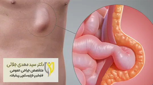 فتق معده فتق معده