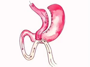 بای پس معده و کاهش وزن