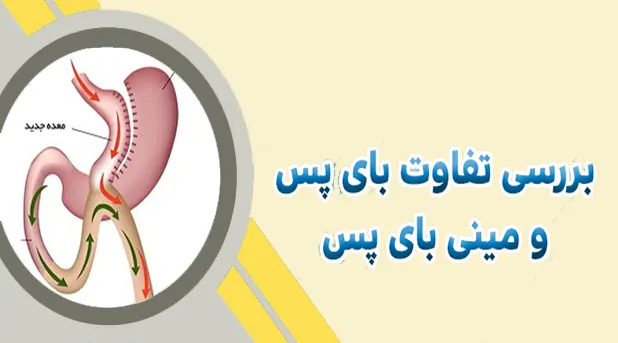 تفاوت روش های بای پس