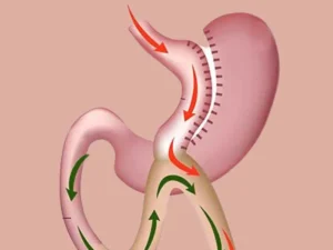 فرق بای پس کلاسیک و مینی