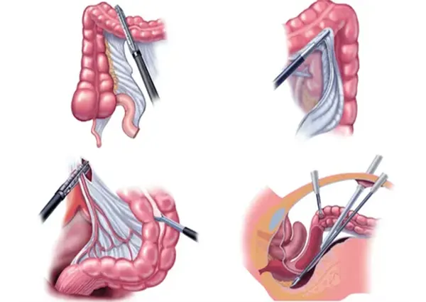 لاپاراسکوپی روده
