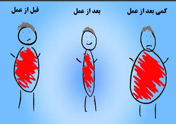 چاقی مجدد بعد از بای پس معده