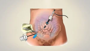 هزینه جراحی لاپاراسکوپی روده در تهران