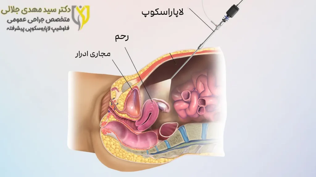 بیمه چقدر هزینههای جراحی لاپاراسکوپی روده را پوشش میدهد؟