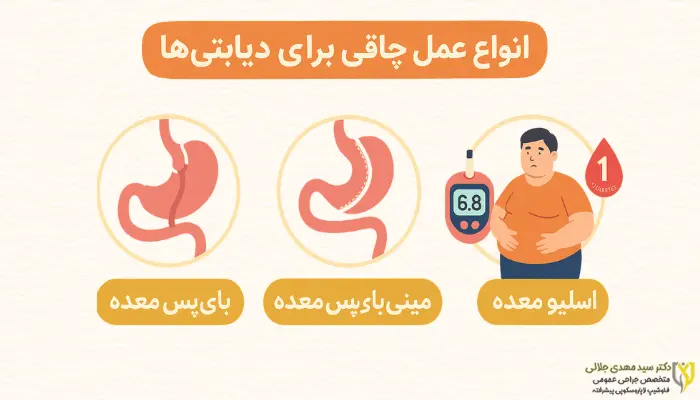 انواع عمل چاقی برای دیابتیها