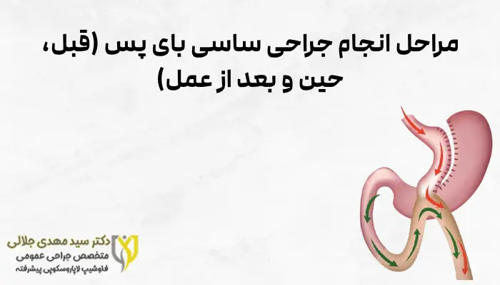 مراحل انجام جراحی ساسی بای پس (قبل، حین و بعد از عمل)